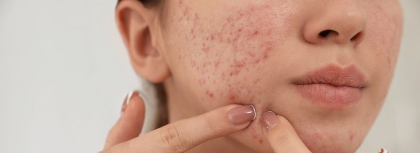 cure-de-zinc-contre-acne